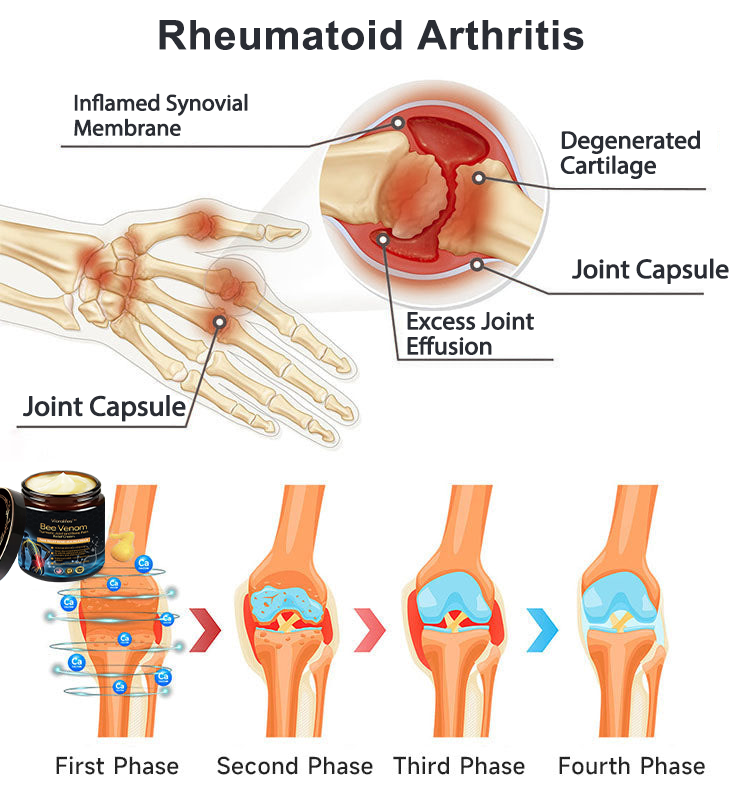 Vioralifesโข Bee Venom and Turmeric Joint and Bone Pain Relief Cream ๐จโโ๏ธ Approved by the American Academy of Orthopaedic Surgeons (AAOS)