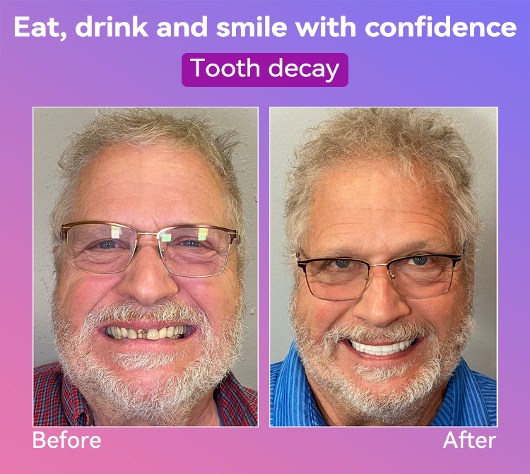 Vioralifes® Next-Generation Comfort Dentures 🦷(Luxurious dentures, lightweight and easy to wear — limited-time 70% OFF)