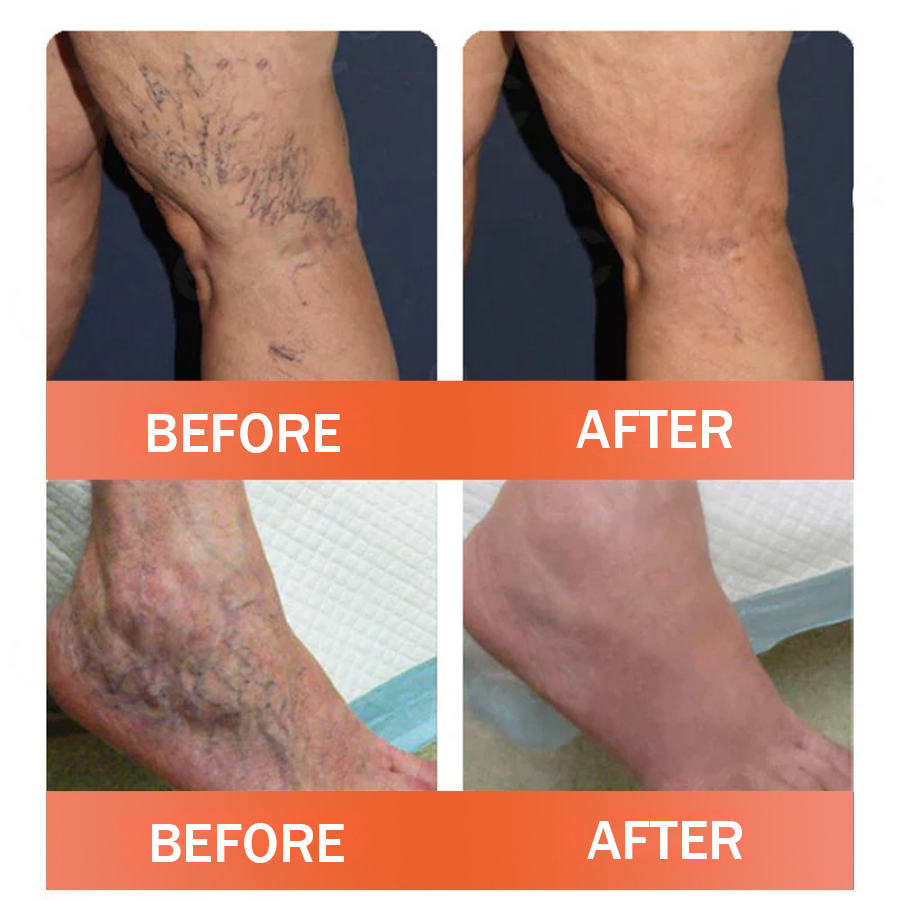 Natravor™ VeinEase Microneedle Therapy Patch