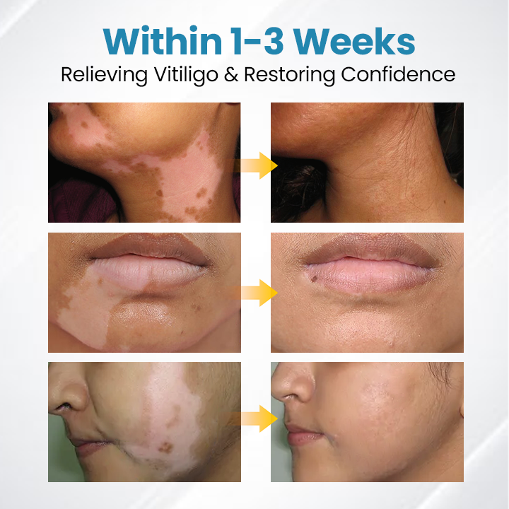 Natravor® DermaBeam Vitiligo Therapy Device ✅3-5 Second Vitiligo Treatment, Visible Results in Just 2 Weeks