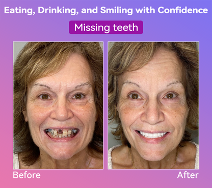 Vioralifes® Next-Generation Comfort Dentures 🦷(Luxurious dentures, lightweight and easy to wear — limited-time 70% OFF)