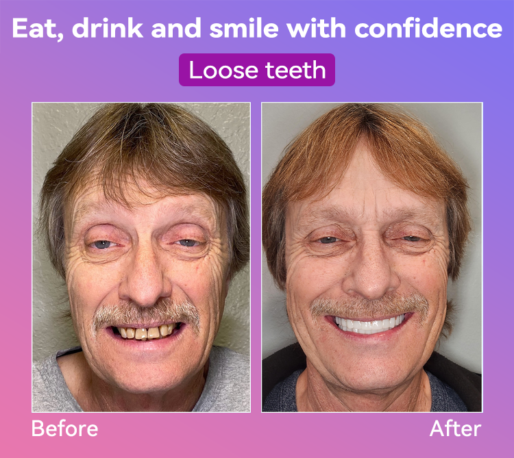 Vioralifes® Next-Generation Comfort Dentures 🦷(Luxurious dentures, lightweight and easy to wear — limited-time 70% OFF)