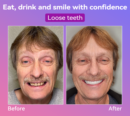 Vioralifes® Next-Generation Comfort Dentures 🦷(Luxurious dentures, lightweight and easy to wear — limited-time 70% OFF)