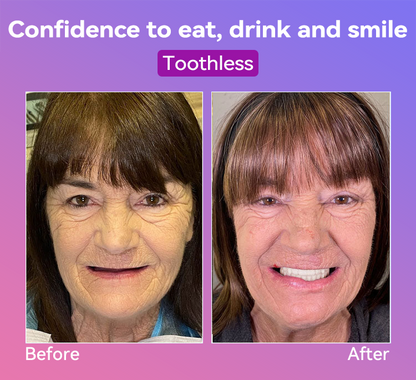 Vioralifes® Next-Generation Comfort Dentures 🦷(Luxurious dentures, lightweight and easy to wear — limited-time 70% OFF)