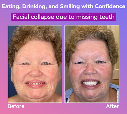 Vioralifes® Next-Generation Comfort Dentures 🦷(Luxurious dentures, lightweight and easy to wear — limited-time 70% OFF)