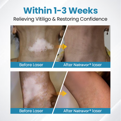 Natravor® DermaBeam Vitiligo Therapy Device ✅3-5 Second Vitiligo Treatment, Visible Results in Just 2 Weeks
