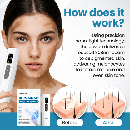 Natravor® DermaBeam Vitiligo Therapy Device ✅3-5 Second Vitiligo Treatment, Visible Results in Just 2 Weeks