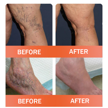 Natravor™ VeinEase Microneedle Therapy Patch
