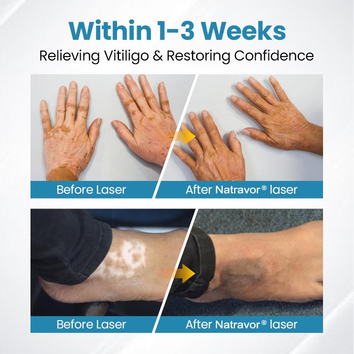 Natravor® DermaBeam Vitiligo Therapy Device ✅3-5 Second Vitiligo Treatment, Visible Results in Just 2 Weeks