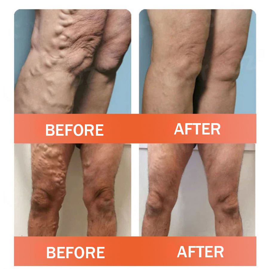 Natravor™ VeinEase Microneedle Therapy Patch