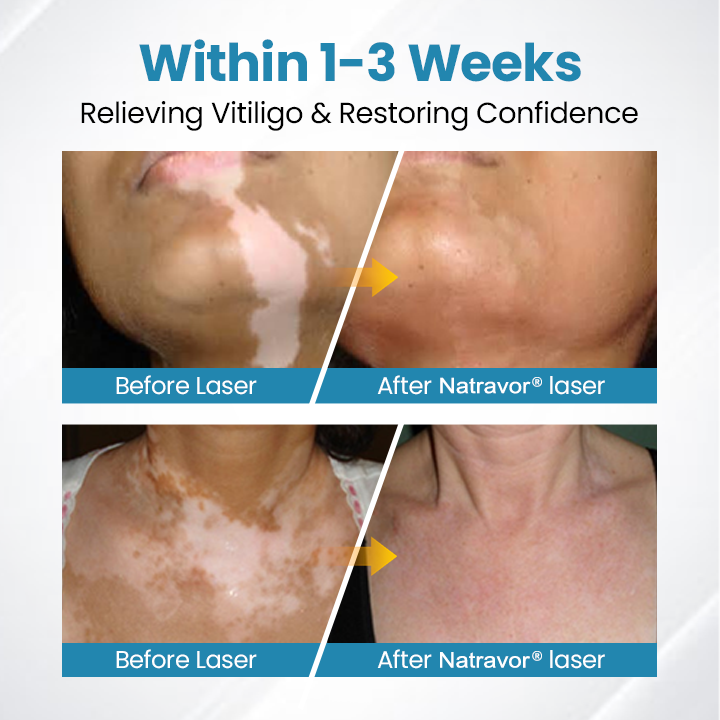 Natravor® DermaBeam Vitiligo Therapy Device ✅3-5 Second Vitiligo Treatment, Visible Results in Just 2 Weeks