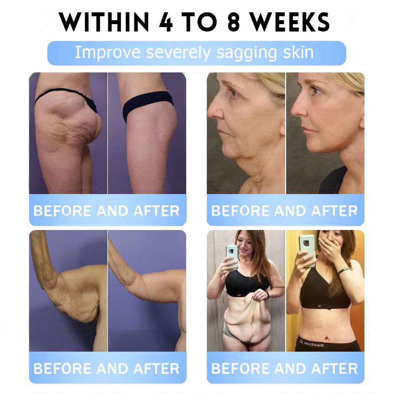 FDA Store·𝐍𝐚𝐭𝐫𝐚𝐯𝐨𝐫®𝐒𝐥𝐢𝐦 & 𝐅𝐢𝐫𝐦 𝐍𝐚𝐧𝐨 𝐌𝐢𝐜𝐫𝐨𝐧𝐞𝐞𝐝𝐥𝐞 𝐏𝐚𝐭𝐜𝐡 𝐰𝐢𝐭𝐡 𝐌𝐨𝐫𝐢𝐧𝐠𝐚, 𝐎𝐦𝐞𝐠𝐚-𝟑, 𝐂𝐨𝐥𝐥𝐚𝐠𝐞𝐧 𝐏𝐞𝐩𝐭𝐢𝐝𝐞𝐬, 𝐍𝐀𝐃 & 𝐍𝐌𝐍 𝐟𝐨𝐫 𝐎𝐛𝐞𝐬𝐢𝐭𝐲, 𝐂𝐚𝐫𝐝𝐢𝐨𝐯𝐚𝐬𝐜𝐮𝐥𝐚𝐫 𝐃𝐢𝐬𝐞𝐚𝐬𝐞, 𝐃𝐢𝐚𝐛𝐞𝐭𝐞𝐬, 𝐒𝐥𝐞𝐞𝐩 𝐀𝐩𝐧𝐞𝐚, 𝐉𝐨𝐢𝐧𝐭 𝐏𝐫𝐨𝐛𝐥𝐞𝐦𝐬, 𝐒𝐤𝐢𝐧 𝐅𝐢𝐫𝐦𝐢𝐧𝐠, 𝐀𝐧𝐭𝐢-𝐀𝐠𝐢𝐧𝐠, 𝐚𝐧𝐝 𝐌𝐨𝐫𝐞