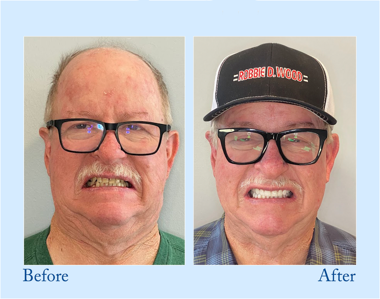 NESLEMY™ - Premium Denture