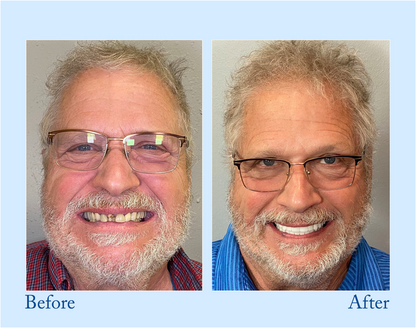 NESLEMY™ - Premium Denture