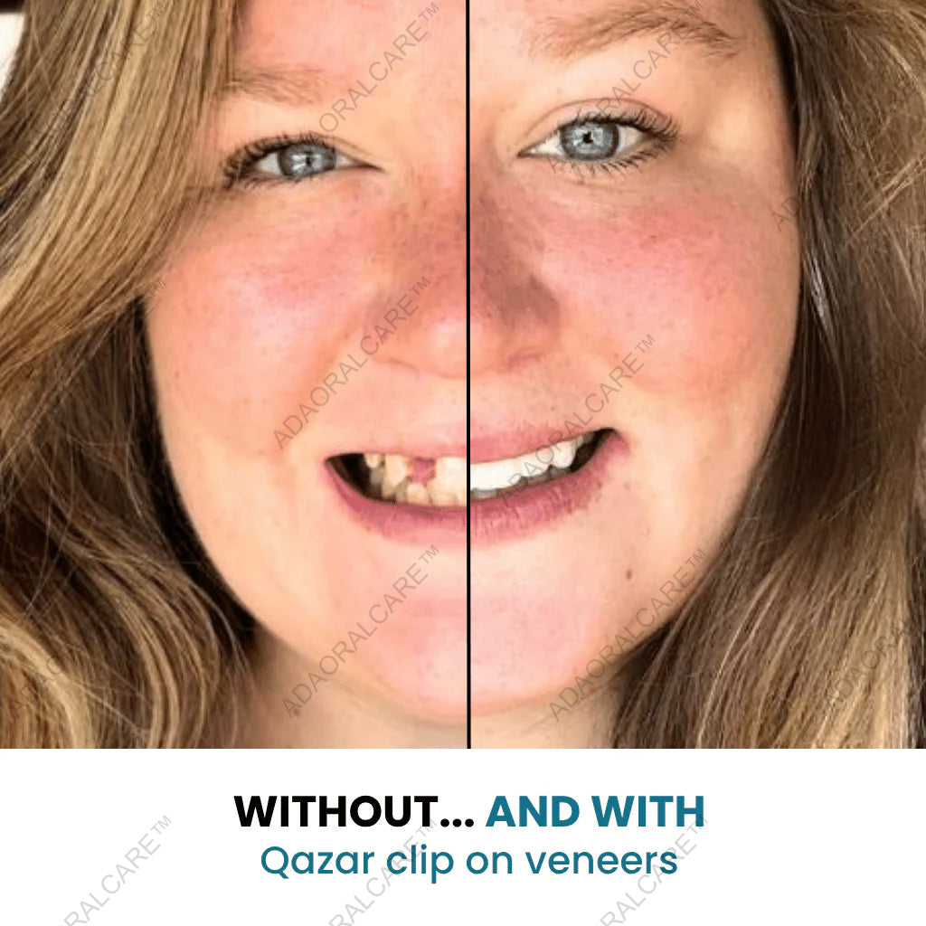 ADAORALCARE™Clip-On Veneers — Instant, Custom Fit Smile in Seconds