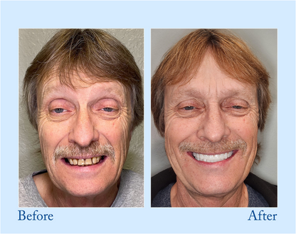 NESLEMY™ - Premium Denture