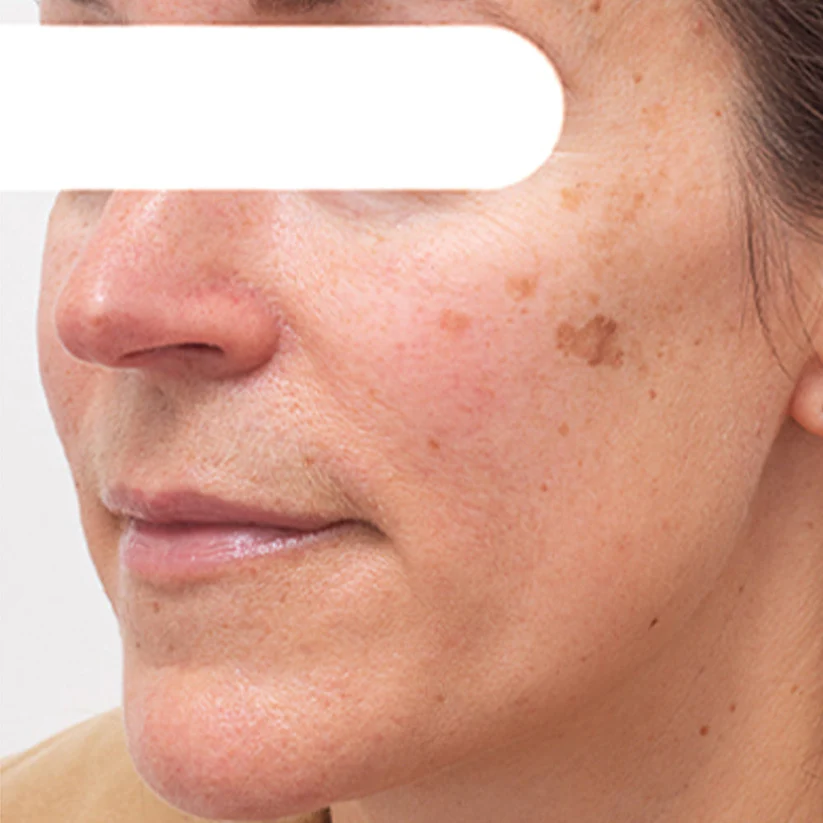 Herbal Spots Peel-Off Facial Mask | LIMITED DISCOUNT OFFER✨