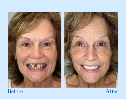 NESLEMY™ - Premium Denture
