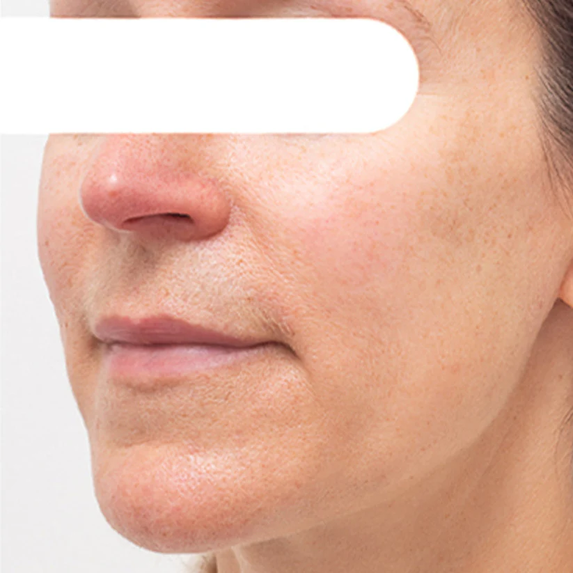 Herbal Spots Peel-Off Facial Mask | LIMITED DISCOUNT OFFER✨
