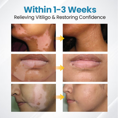 Natravor® DermaBeam Vitiligo Therapy Device ✅3-5 Second Vitiligo Treatment, Visible Results in Just 2 Weeks